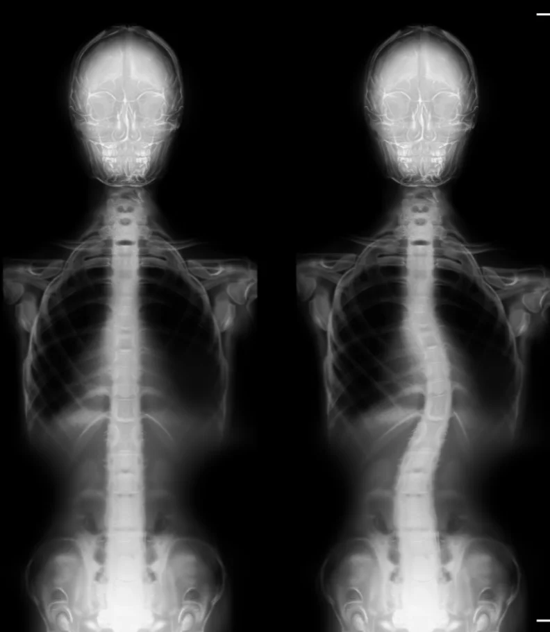 Scoliosis Centennial