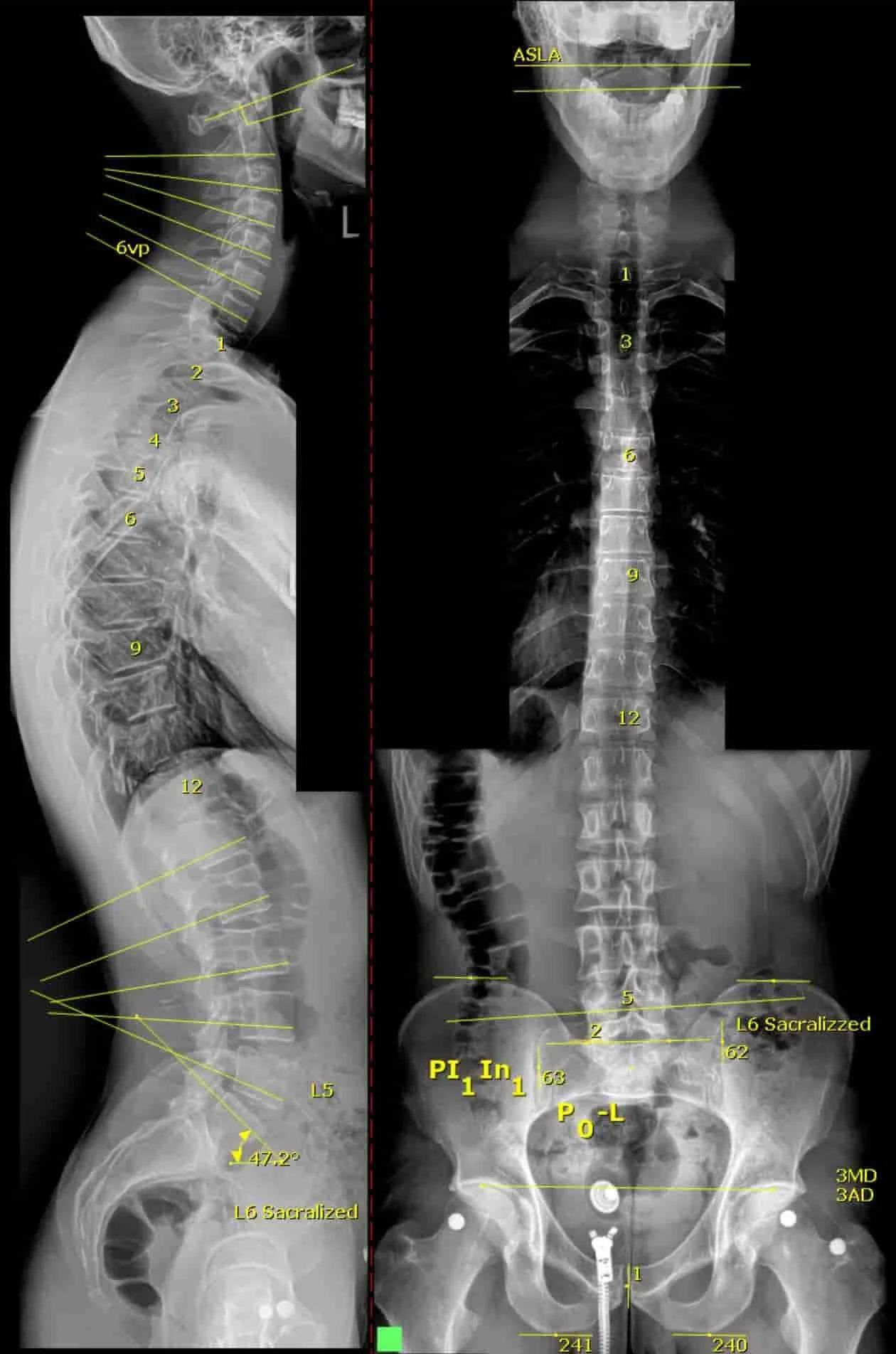 Gonstead-full-spine-xrays