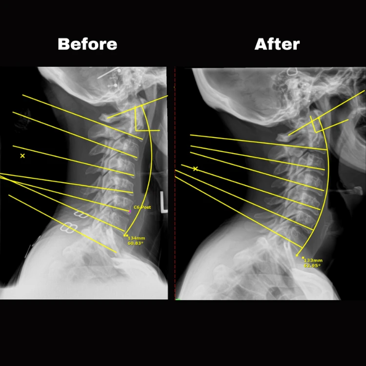 second chiropractic visit