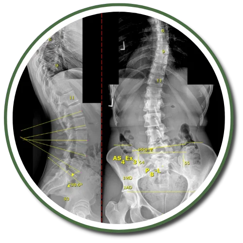 Gonstead X-Rays Centennial